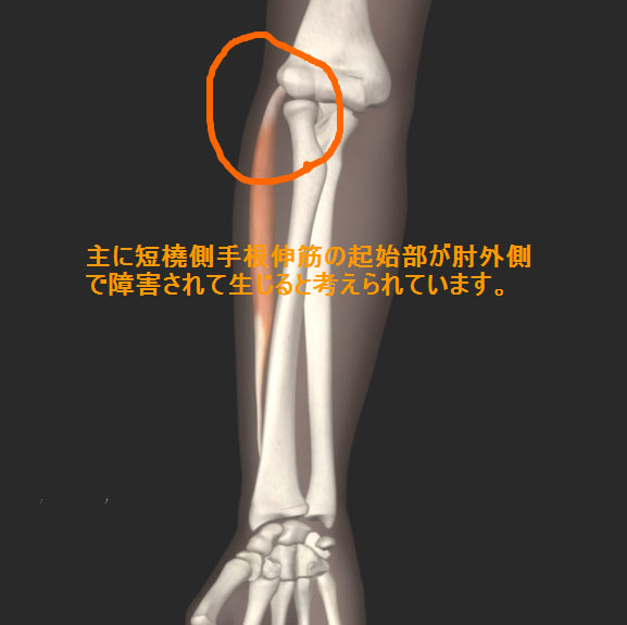 テニス肘　短橈側主根伸筋起始部外側