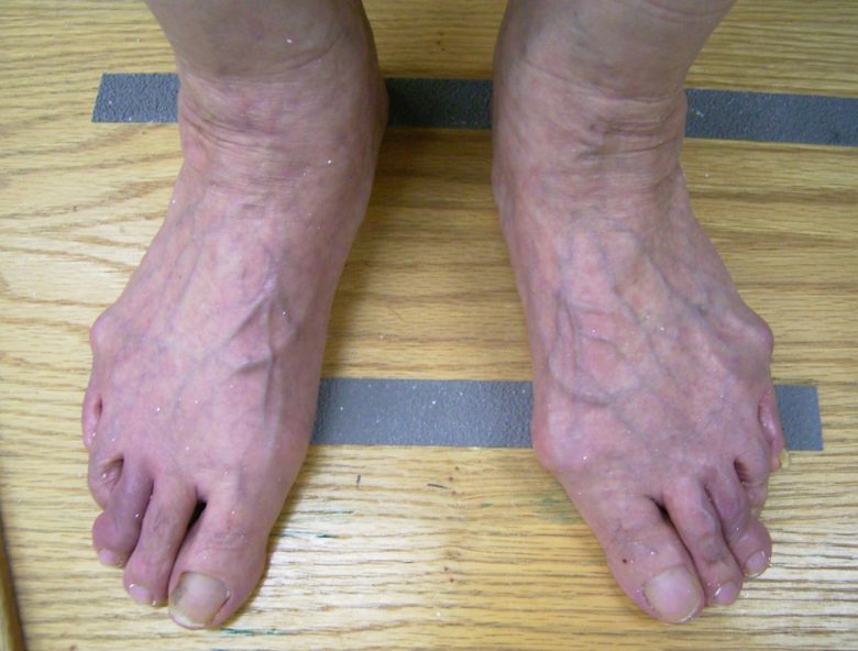 間違いだらけの外反母趾治療。外反母趾の原因はカカトです！外反母趾は足趾の病気ではありません。