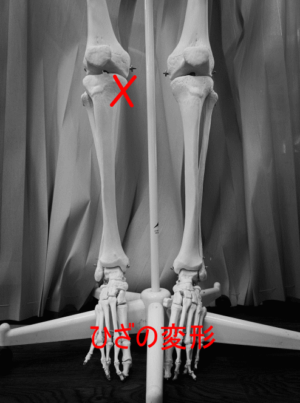 膝の変形